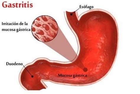 Cómo Prevenir La Gastritis   Causas Y Tratamientos Para La Cura