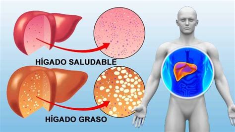 ¿Cómo prevenir o tratar el Hígado Graso?   Terapia Celular