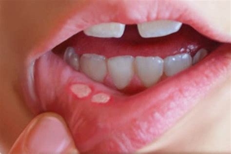 Como Quitar Fogasos De Los Labios   gustotips