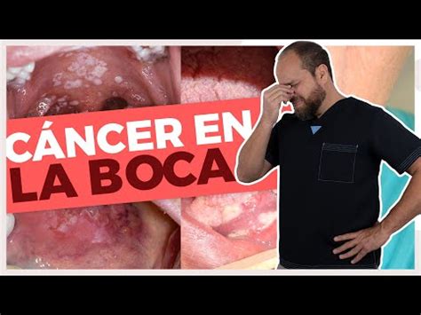 Como Quitar Los Fogasos De Adentro De La Boca   Zuii Organic