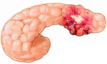Cómo reconocer los síntomas del cáncer de páncreas ...