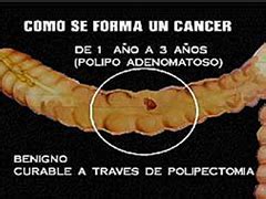 ¿Cómo se forma un cáncer?  gastroenterologia El Salvador ...
