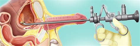 ¿Cómo se hace la cistoscopia?   Unidad Privada de Urologia