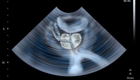 ¿Cómo se realiza una ecografía de próstata? • Portal de salud