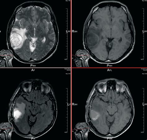 Como supero mi glioblastoma: Puntos fuera y malas noticias