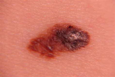 ¿Cómo tratar un tumor benigno en la piel?
