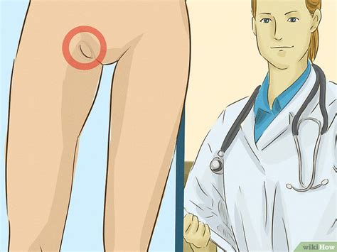 Cómo tratar una lesión de la ingle: 20 pasos