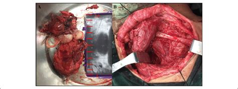 Complete excision of the cervical teratoma extending to the anterior ...