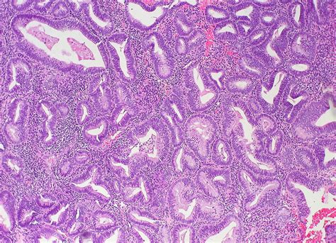 Complex Hyperplasia of the Endometrium  no atypia  | Flickr