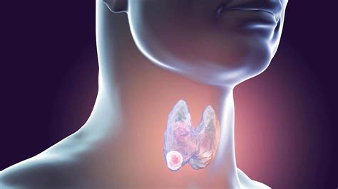 Complicaciones del cáncer de garganta Mejor con Salud