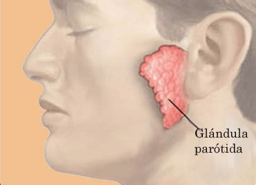 Complicaciones del cáncer de glándula parótida   Glándula Parótida