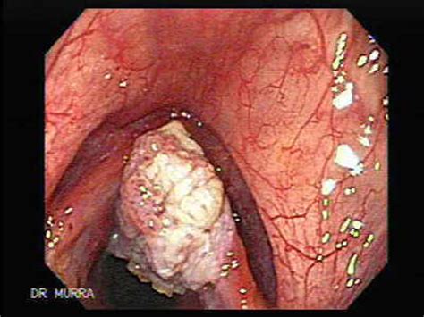 Conceptos y procedimientos de la salud: Cancer de laringe