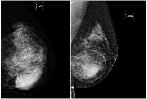 Concomitant phyllodes tumour and hamartoma of the breast   MedCrave online