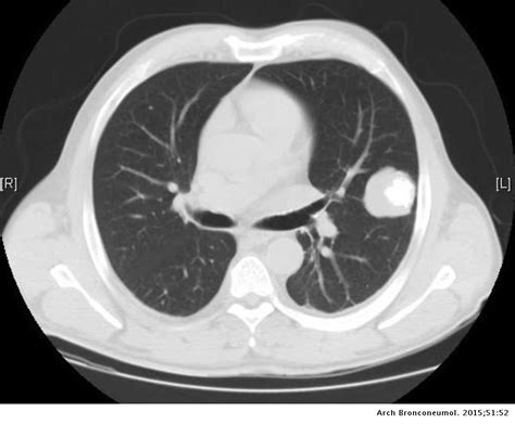 Condrosarcoma pulmonar metastásico: descripción clínica y revisión de ...