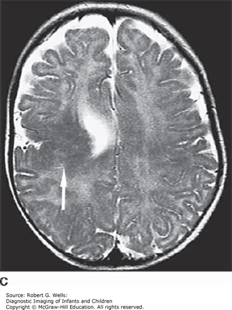 Congenital Abnormalities of the Brain | Obgyn Key