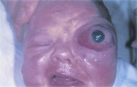 Congenital cystic teratoma   American Academy of Ophthalmology