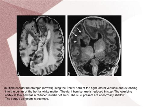 Congenital malformations of brain