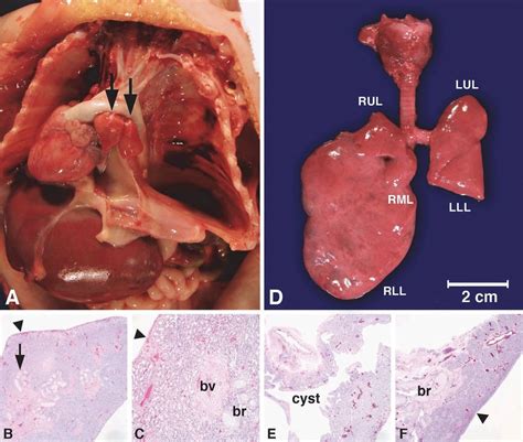 Congenital Malformations of the Lung | Thoracic Key