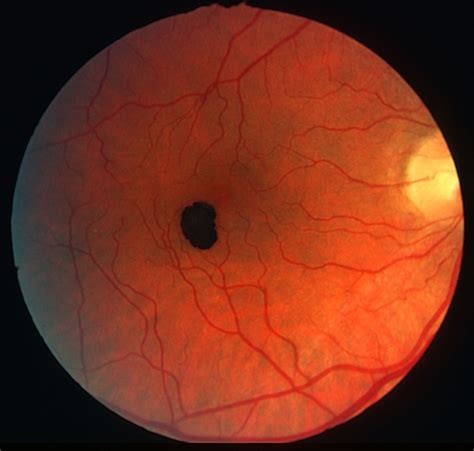 Congenital RPE hamartoma   Retina Image Bank