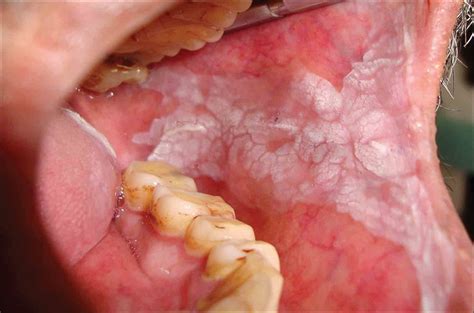 Conheça 2 tipos de tumores malignos relacionados à boca ...