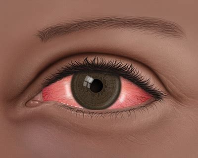 Conjunctivitis: What Is Pink Eye?   American Academy of ...