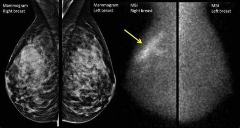 Conoce una nueva alternativa para la detección de cáncer de mama