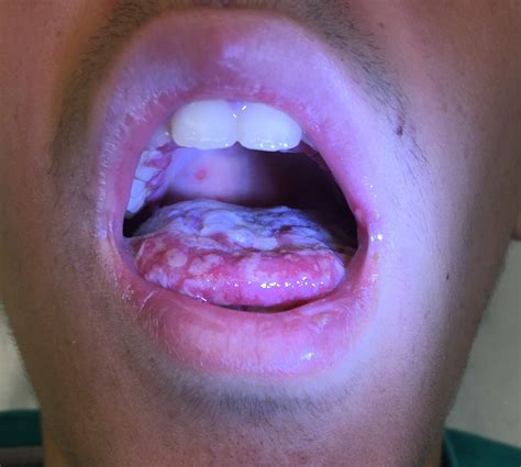 Continuum: Varón de 17 años con fiebre alta y odinofagia intensa