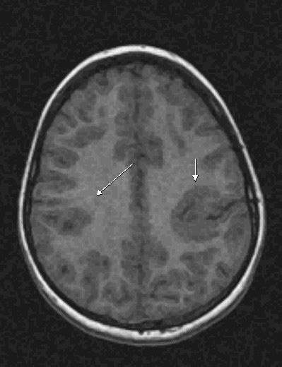 Cortical Dysplasia MRI   Sumer s Radiology Blog