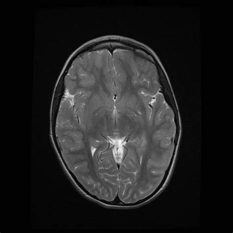 Cortical dysplasia | Radiology Case | Radiopaedia.org