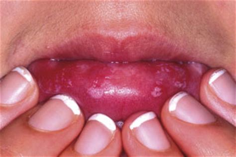 Could you identify oral cancer? : Pharmacy Magazine