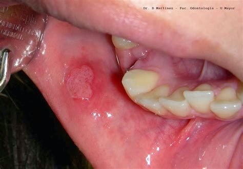 Crónica Dental del Siglo XXI: Lesiones sospechosas de ...