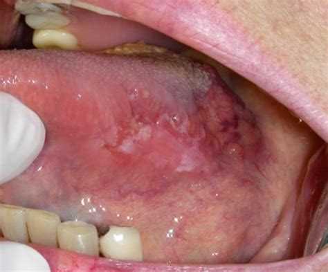 Cảnh giác với 3 dấu hiệu liên quan đến ung thư lưỡi   Benh.vn