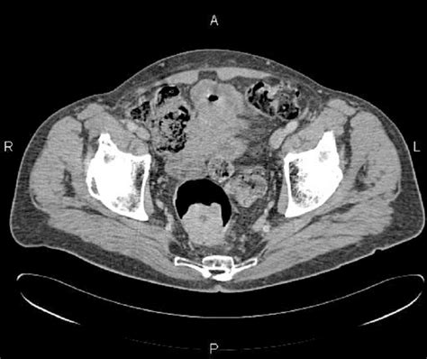 CT scan of the same patient showing high rectal cancer ...