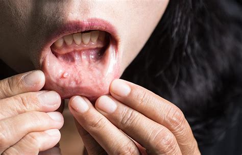 ¿Cuál es el cáncer oral y cuáles son sus síntomas?