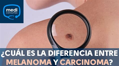 ¿Cuál es la diferencia entre melanoma y carcinoma? #MediConsultas   YouTube