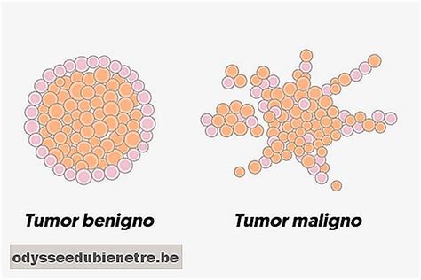 Cuál es la diferencia entre tumor, cáncer y neoplasia   es ...