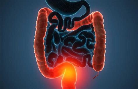 Cuáles son las causas prevenibles del cáncer de colon