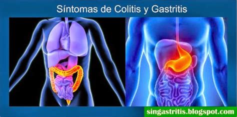 ¿Cuáles son las diferencias entre los Síntomas de Colitis y Gastritis ...