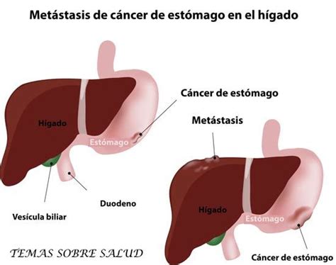 Cuales son las Diferencias Entre Tumores Benignos y Malignos