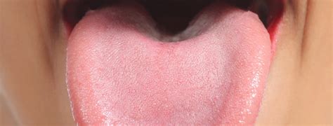 ¿Cuáles son las enfermedades más comunes de la lengua?   Clínicas ...