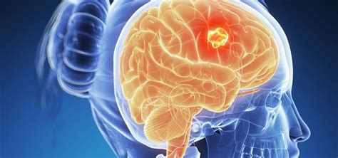 ¿Cuáles son los efectos de un tumor cerebral?   Gamma Knife