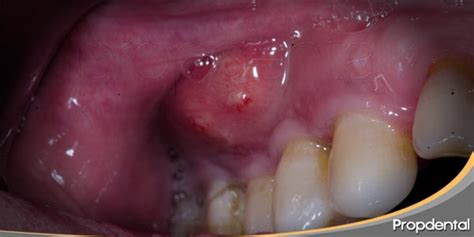 ¿Cuales son los remedios caseros para los abscesos dentales?