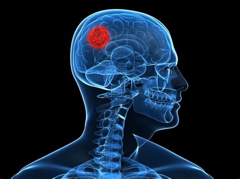 ¿Cuáles son los síntomas de tumores cerebrales?   Gamma Knife