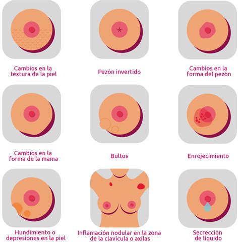 ¿Cuáles son los síntomas del cáncer de mama? | Nacional ...