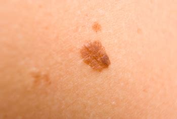 ¿Cuáles son los síntomas del cáncer de piel? | CDC