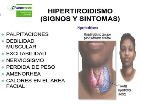 ¿Cuáles son los síntomas del hipertiroidismo? Entre los ...