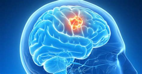 ¿Cuáles son los síntomas del tumor cerebral?