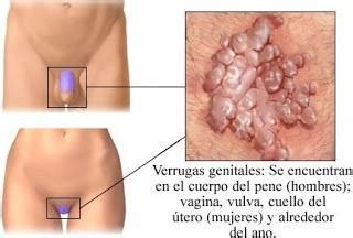 Cuáles son los síntomas del Virus del Papiloma Humano ...