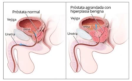 Cuando la Próstata va Creciendo | Blogs Quirónsalud