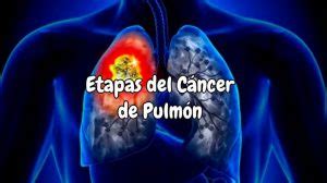 Cuántas etapas tiene el cáncer de pulmón 【Microcítico y no ...